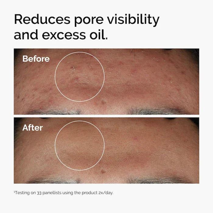 The Ordinary - Niacinamide 10% + Zinc 1%  Serum for Oily Skin